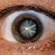 Cataracts Quiz