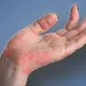 Psoriasitic Arthritis Quiz