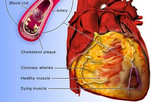 Picture of Heart Disease